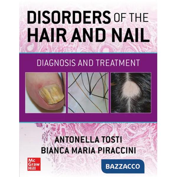 Disorders of the hair and nail: diagnosis and treatment