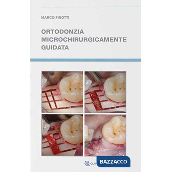 Ortodonzia microchirurgicamente guidata