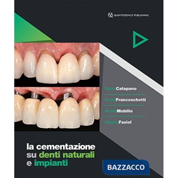 Cementazione su denti naturali e impianti (La)