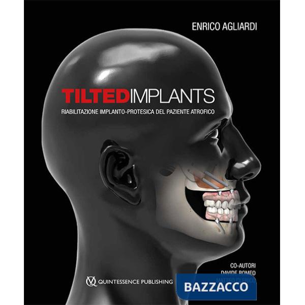 Tilted implants. Riabilitazione implanto-protesica del paziente atrofico