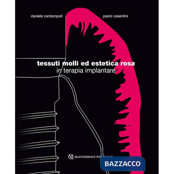 Tessuti molli ed estetica rosa in terapia implantare