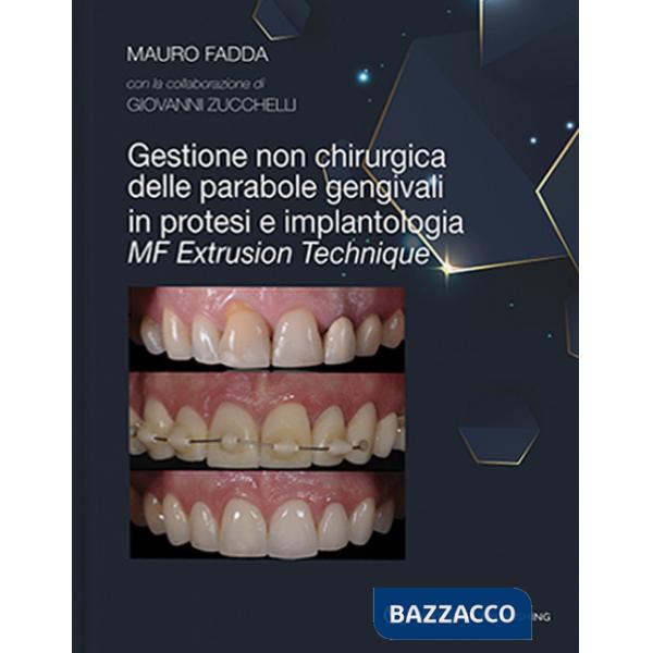 Gestione non chirurgica delle parabole gengivali in protesi e implantologia. MF extrusion technique