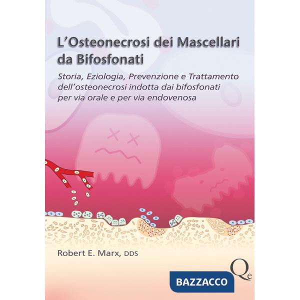 Osteonecrosi dei mascellari da bifosfonati (L')