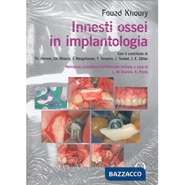 Innesti ossei in implantologia