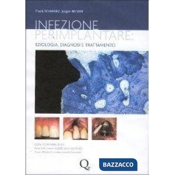 Infezione perimplantare: eziologia, diagnosi e trattamento