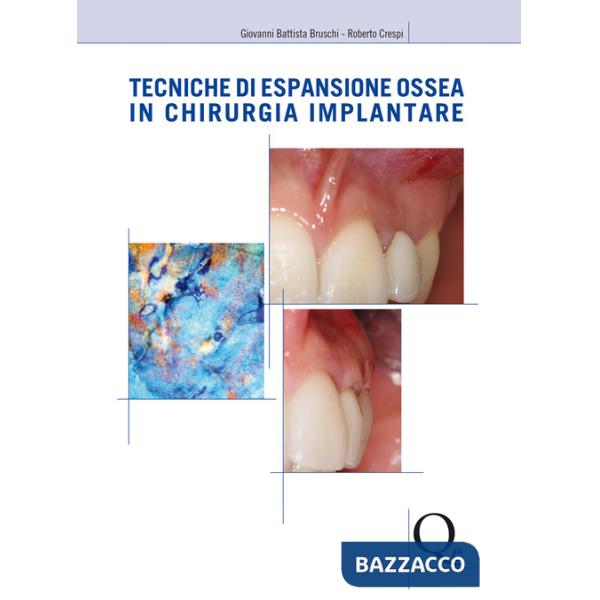 Tecniche di espansione ossea in chirurgia implantare