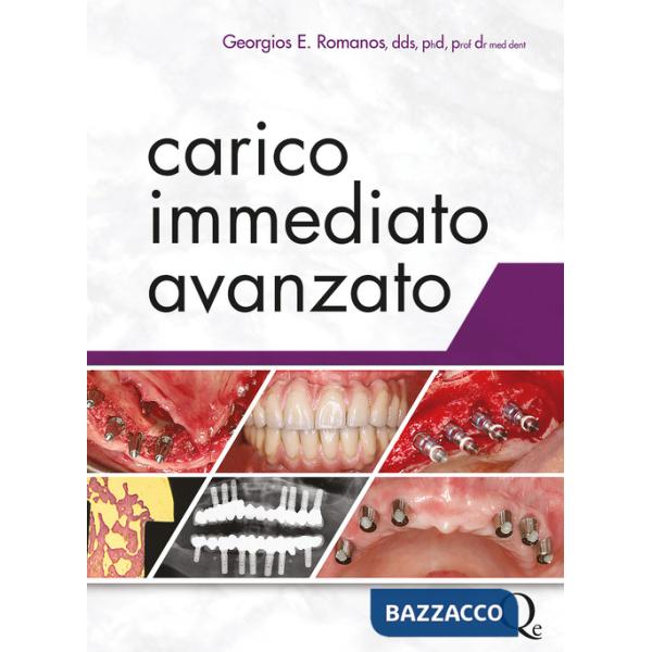 Carico immediato avanzato