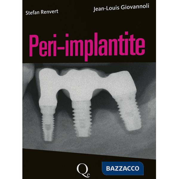 Peri-implantite