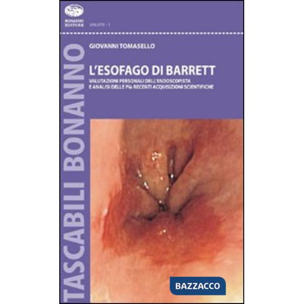 Esofago di Barrett. Valutazioni personali dell'endoscopista e analisi sulle più 