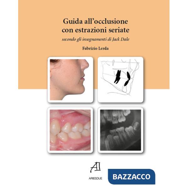 Guida all'occlusione con estrazioni seriate secondo gli insegnamenti di Jack Dale